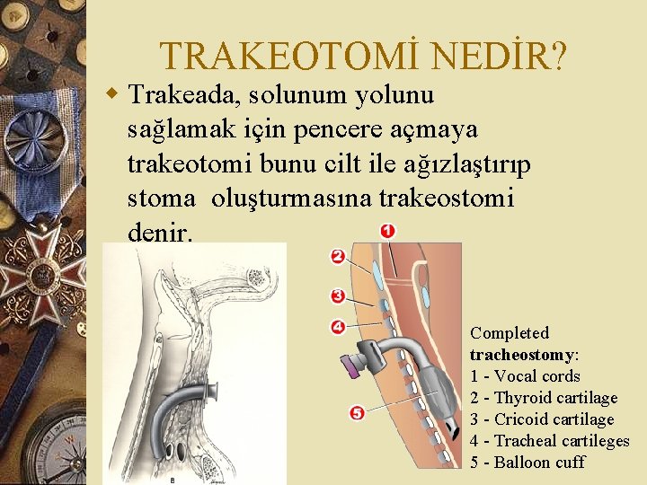 TRAKEOTOMİ NEDİR? w Trakeada, solunum yolunu sağlamak için pencere açmaya trakeotomi bunu cilt ile