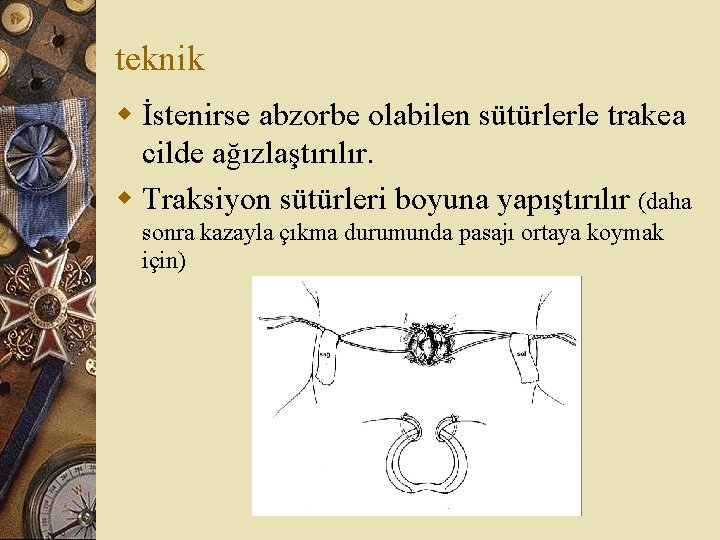 teknik w İstenirse abzorbe olabilen sütürlerle trakea cilde ağızlaştırılır. w Traksiyon sütürleri boyuna yapıştırılır