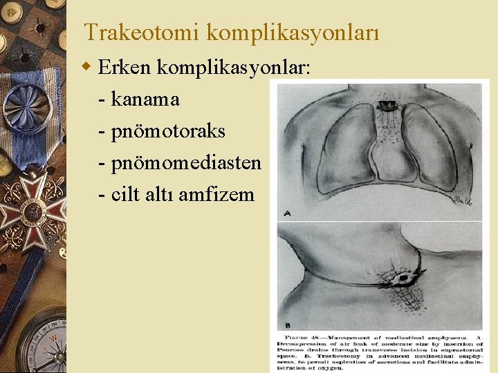 Trakeotomi komplikasyonları w Erken komplikasyonlar: - kanama - pnömotoraks - pnömomediasten - cilt altı