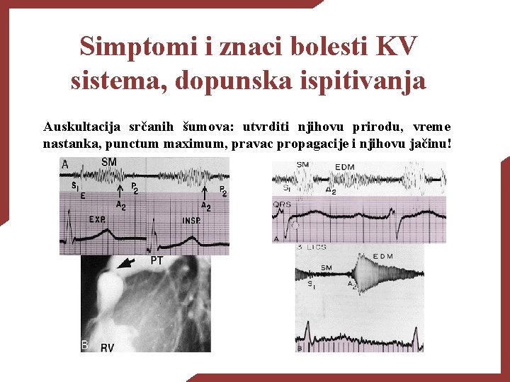 Simptomi i znaci bolesti KV sistema, dopunska ispitivanja Auskultacija srčanih šumova: utvrditi njihovu prirodu,