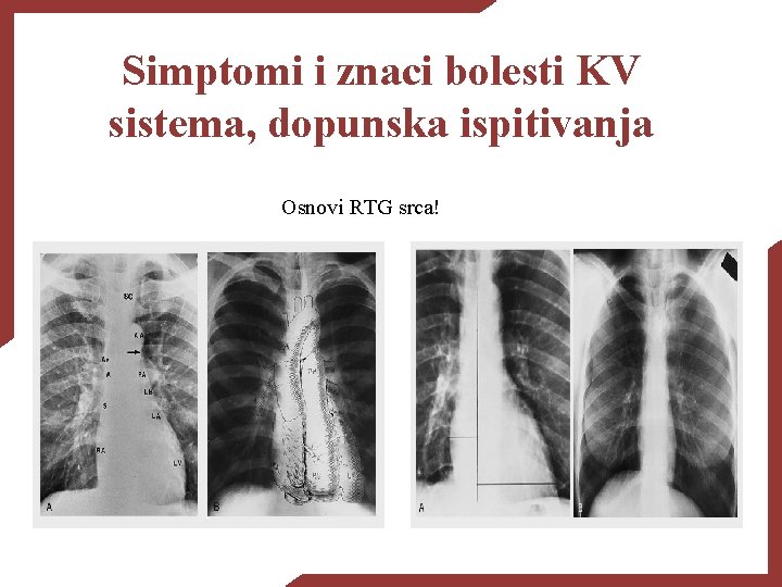 Simptomi i znaci bolesti KV sistema, dopunska ispitivanja Osnovi RTG srca! 