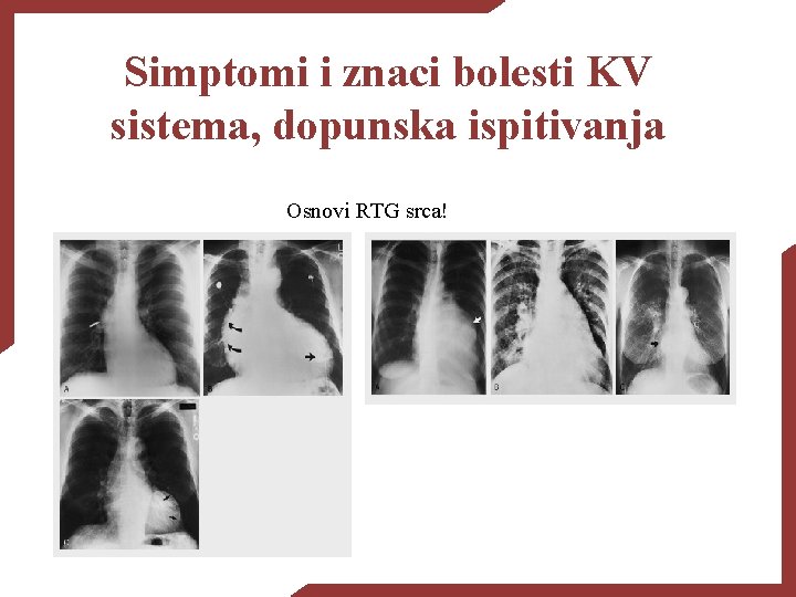 Simptomi i znaci bolesti KV sistema, dopunska ispitivanja Osnovi RTG srca! 