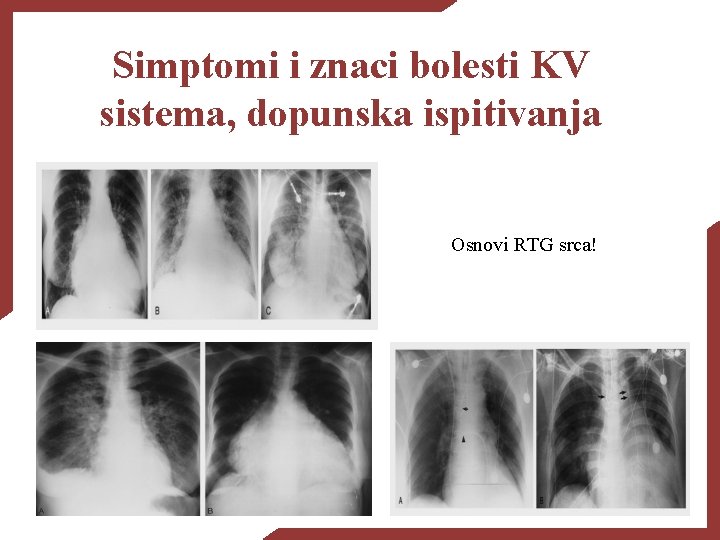 Simptomi i znaci bolesti KV sistema, dopunska ispitivanja Osnovi RTG srca! 