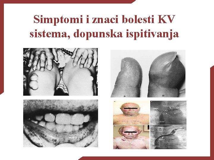 Simptomi i znaci bolesti KV sistema, dopunska ispitivanja 