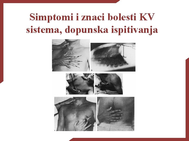 Simptomi i znaci bolesti KV sistema, dopunska ispitivanja 