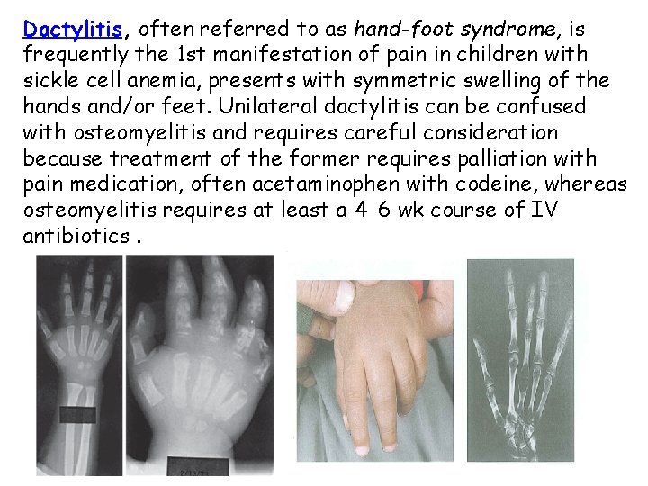 Dactylitis, often referred to as hand-foot syndrome, is frequently the 1 st manifestation of