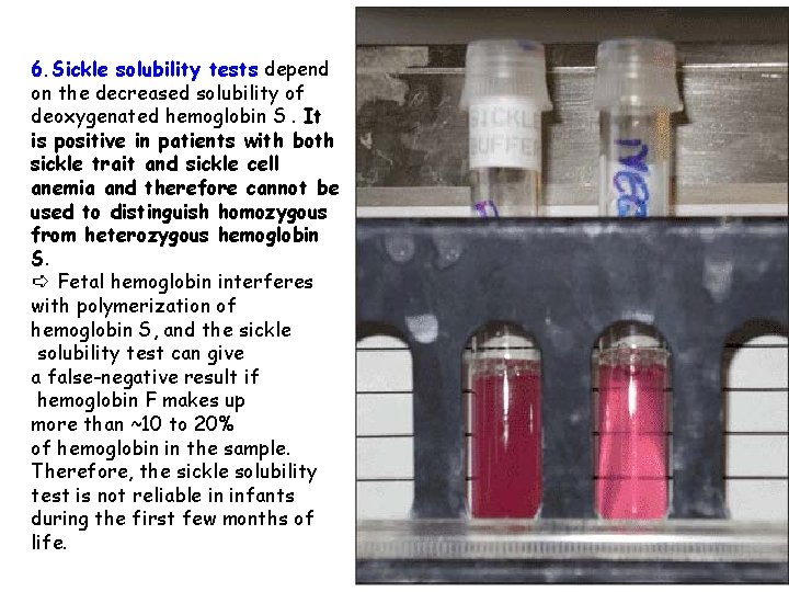 6. Sickle solubility tests depend on the decreased solubility of deoxygenated hemoglobin S. It