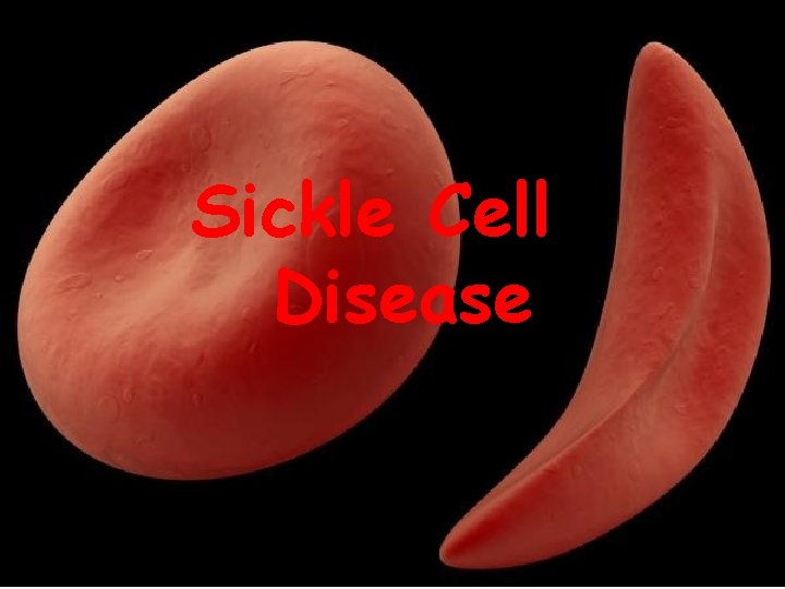 Sickle Cell Disease 