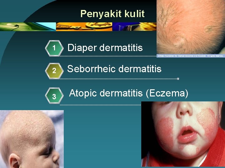 Penyakit kulit 1 Diaper dermatitis 2 Seborrheic dermatitis 3 Atopic dermatitis (Eczema) 