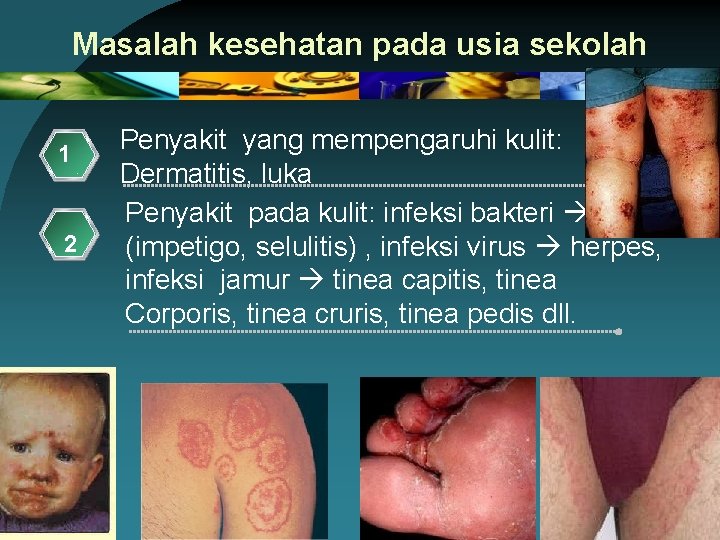 Masalah kesehatan pada usia sekolah 1 2 Penyakit yang mempengaruhi kulit: Dermatitis, luka Penyakit