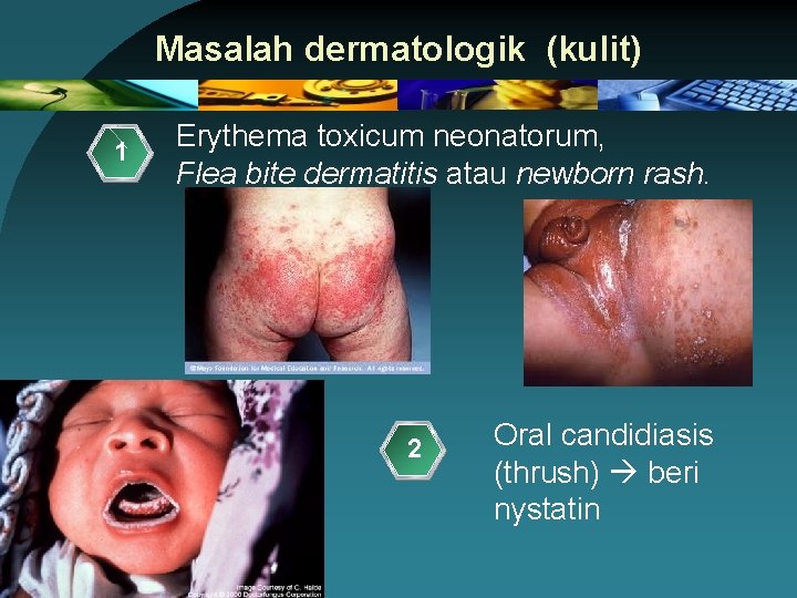 Masalah dermatologik (kulit) 1 Erythema toxicum neonatorum, Flea bite dermatitis atau newborn rash. 2
