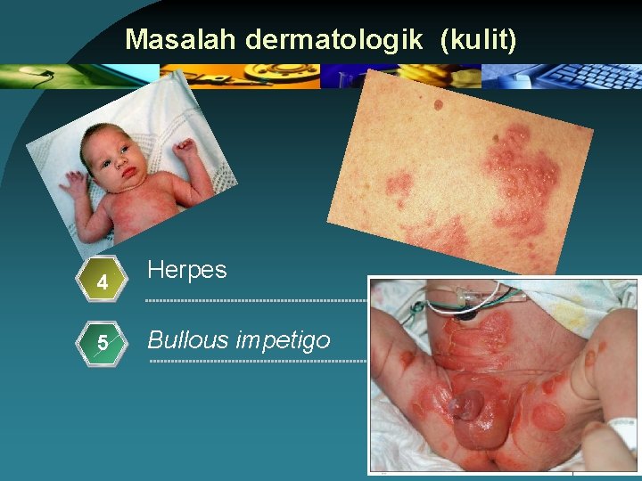 Masalah dermatologik (kulit) 4 5 Herpes Bullous impetigo 