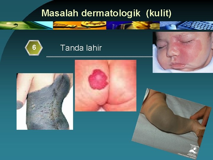 Masalah dermatologik (kulit) 6 Tanda lahir 