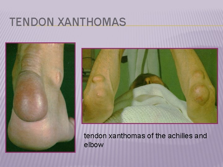 TENDON XANTHOMAS tendon xanthomas of the achilles and elbow 