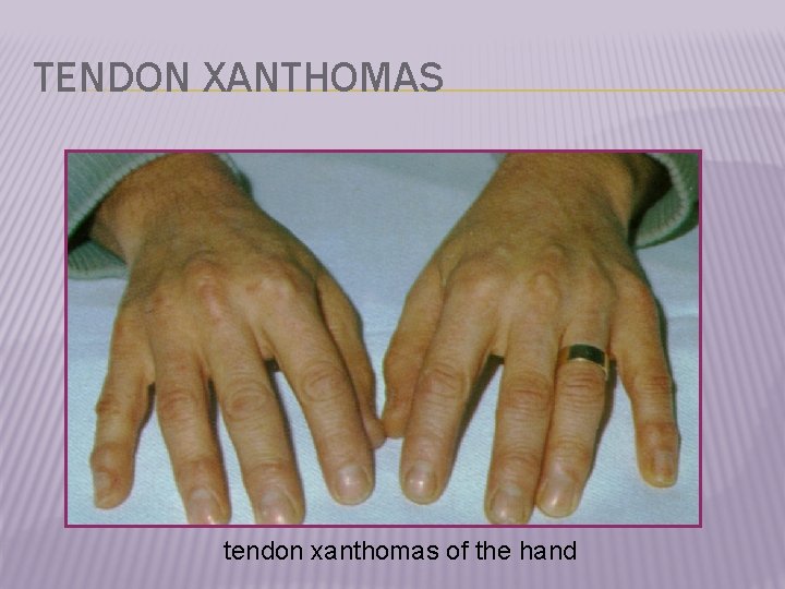 TENDON XANTHOMAS tendon xanthomas of the hand 