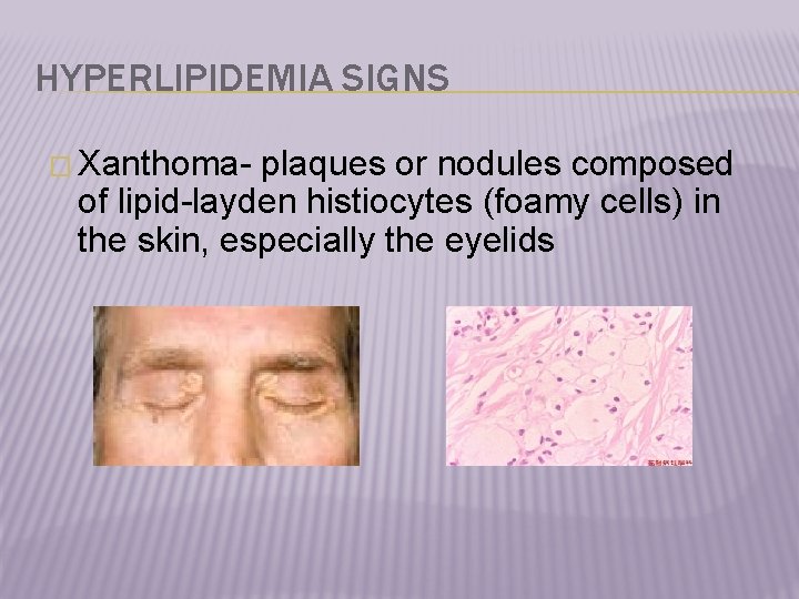HYPERLIPIDEMIA SIGNS � Xanthoma- plaques or nodules composed of lipid-layden histiocytes (foamy cells) in