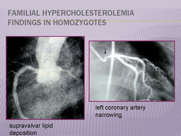 FAMILIAL HYPERCHOLESTEROLEMIA FINDINGS IN HOMOZYGOTES left coronary artery narrowing supravalvar lipid deposition 