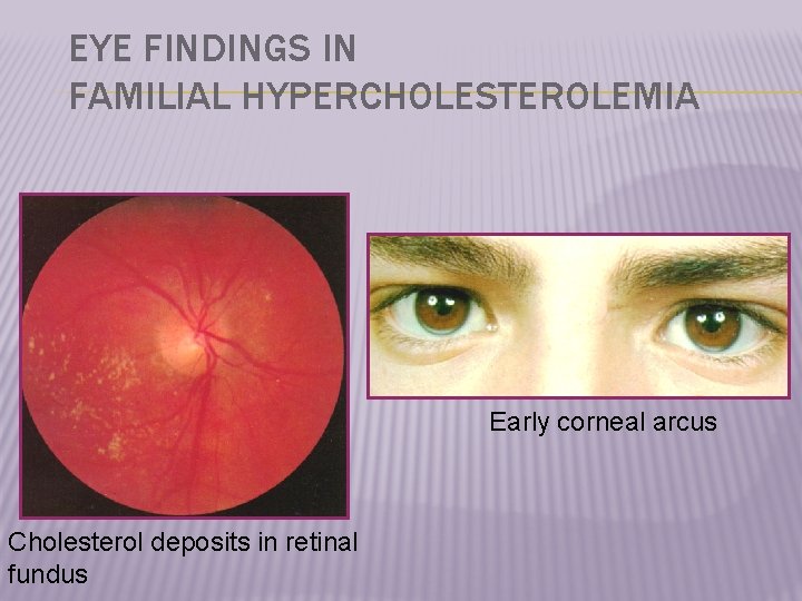 EYE FINDINGS IN FAMILIAL HYPERCHOLESTEROLEMIA Early corneal arcus Cholesterol deposits in retinal fundus 