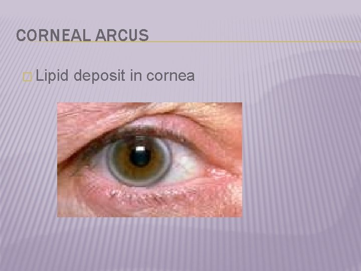 CORNEAL ARCUS � Lipid deposit in cornea 