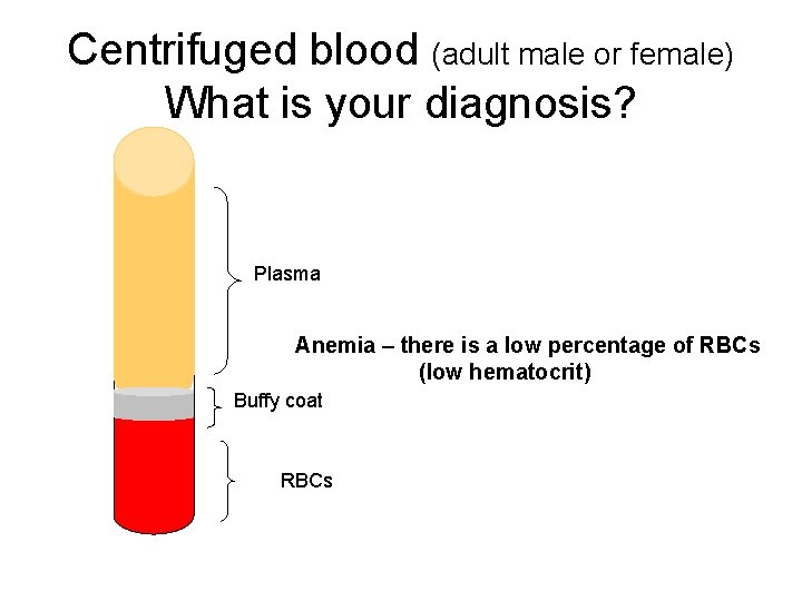 Centrifuged blood (adult male or female) What is your diagnosis? Plasma Anemia – there