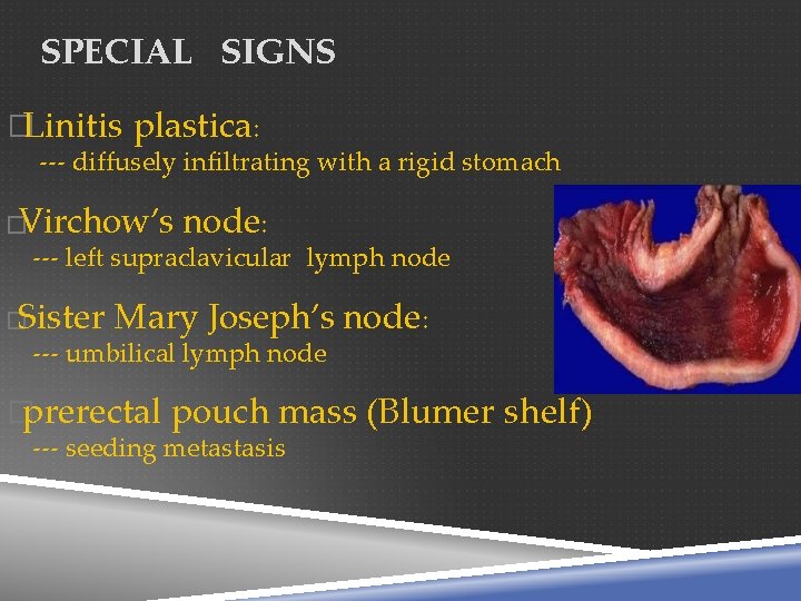 SPECIAL SIGNS �Linitis plastica: --- diffusely infiltrating with a rigid stomach �Virchow’s node: ---