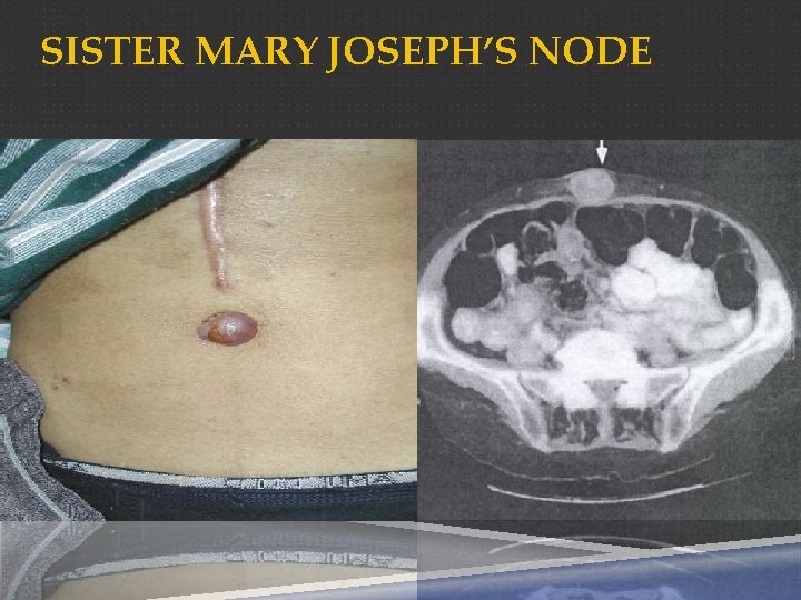 SISTER MARY JOSEPH’S NODE 