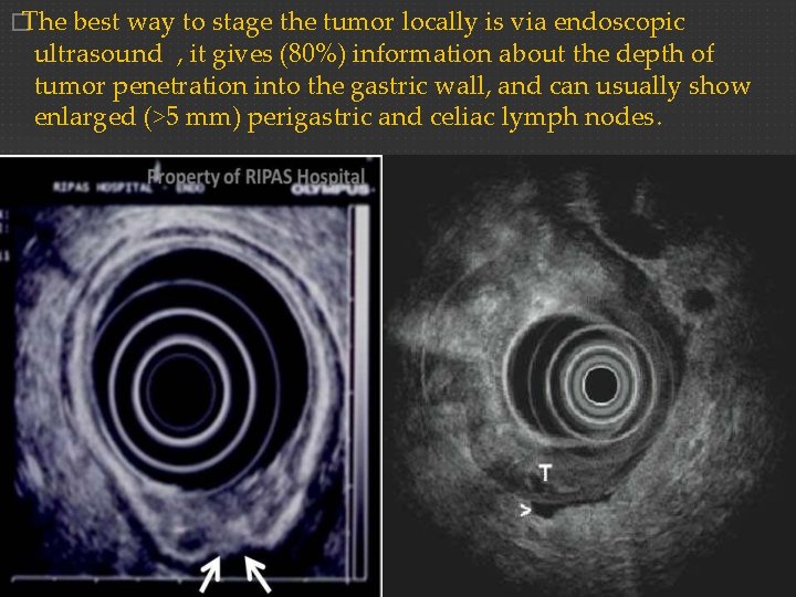�The best way to stage the tumor locally is via endoscopic ultrasound , it