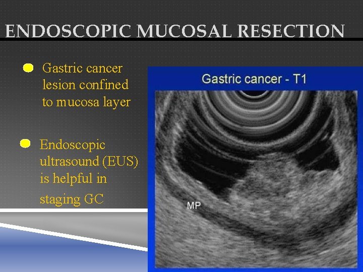 ENDOSCOPIC MUCOSAL RESECTION Gastric cancer lesion confined to mucosa layer Endoscopic ultrasound (EUS) is