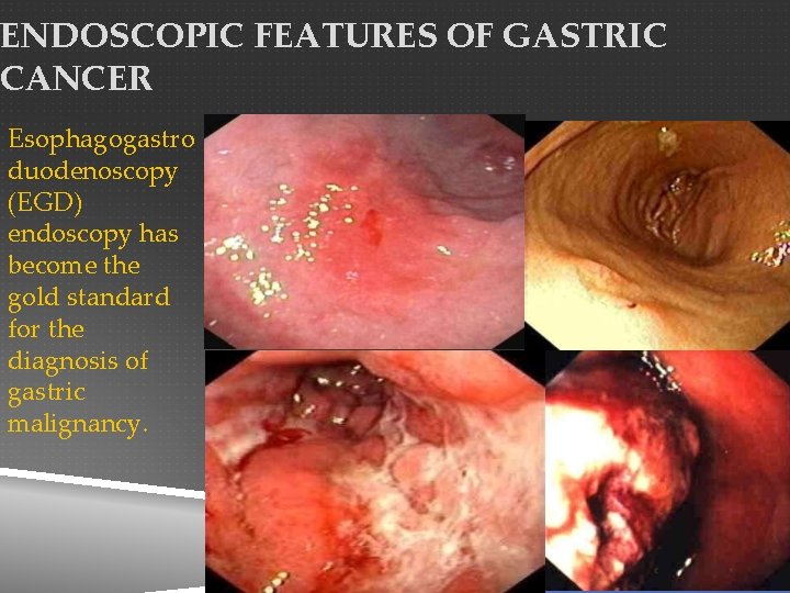 ENDOSCOPIC FEATURES OF GASTRIC CANCER Esophagogastro duodenoscopy (EGD) endoscopy has become the gold standard