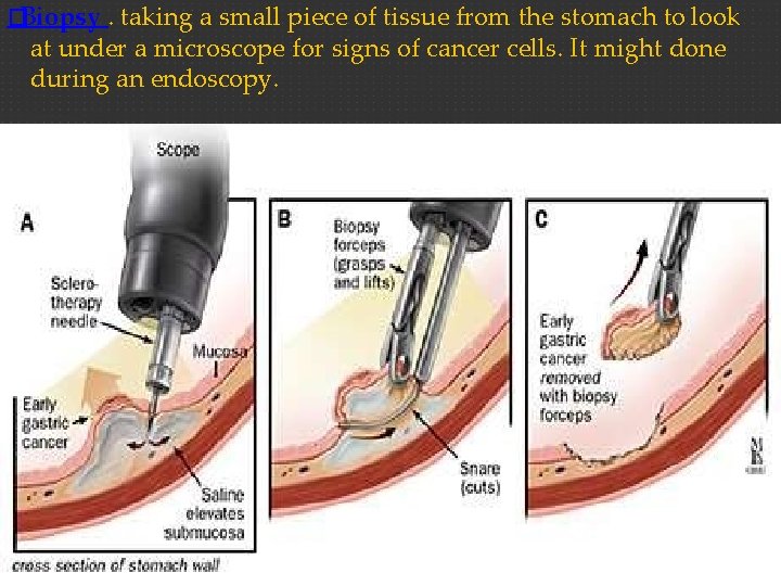 �Biopsy. taking a small piece of tissue from the stomach to look at under