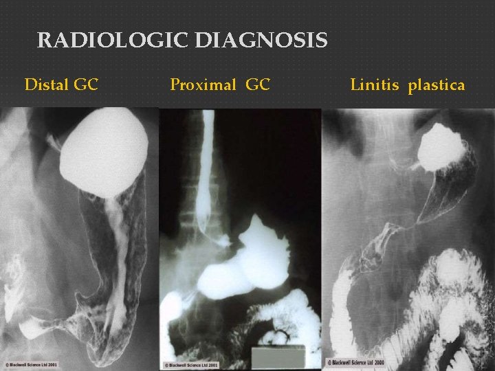 RADIOLOGIC DIAGNOSIS Distal GC Proximal GC Linitis plastica 