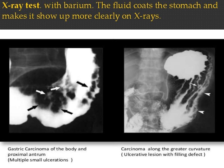 X-ray test. with barium. The fluid coats the stomach and makes it show up