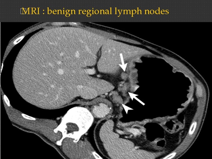� MRI : benign regional lymph nodes 