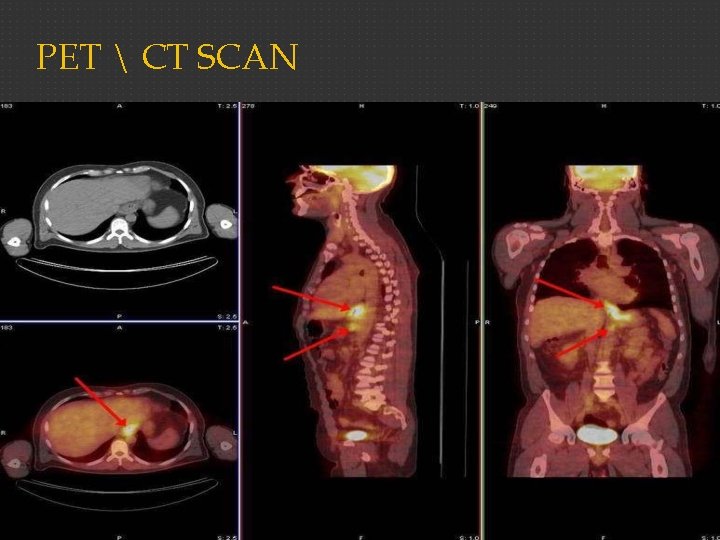 PET  CT SCAN 