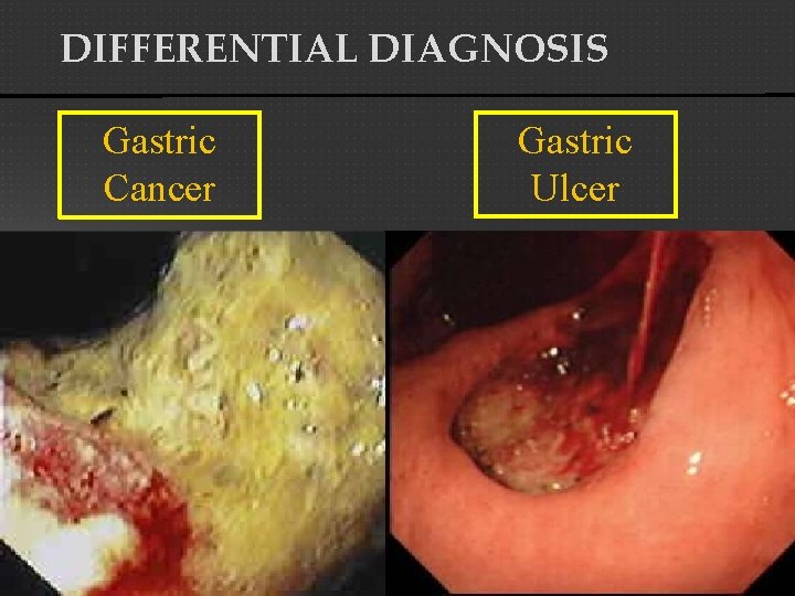 DIFFERENTIAL DIAGNOSIS Gastric Cancer Gastric Ulcer 