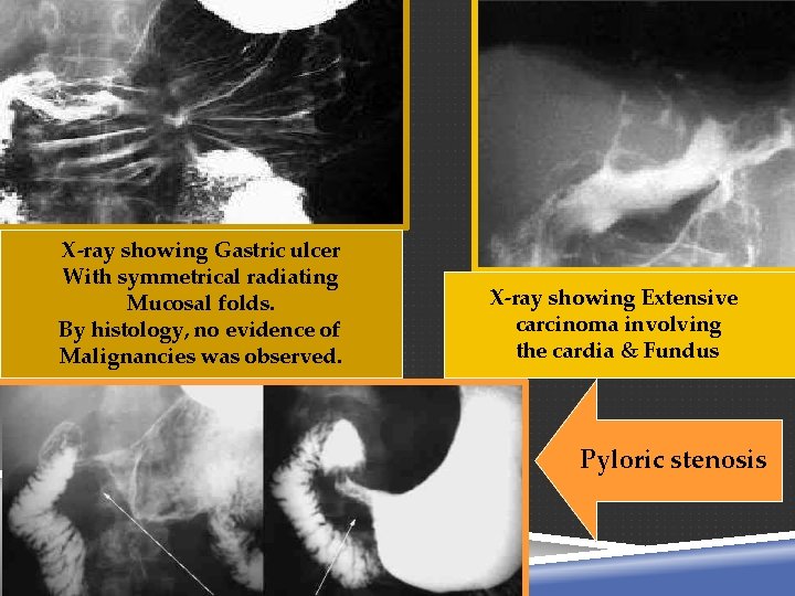 X-ray showing Gastric ulcer With symmetrical radiating Mucosal folds. By histology, no evidence of