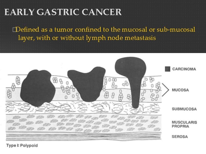 EARLY GASTRIC CANCER �Defined as a tumor confined to the mucosal or sub-mucosal layer,