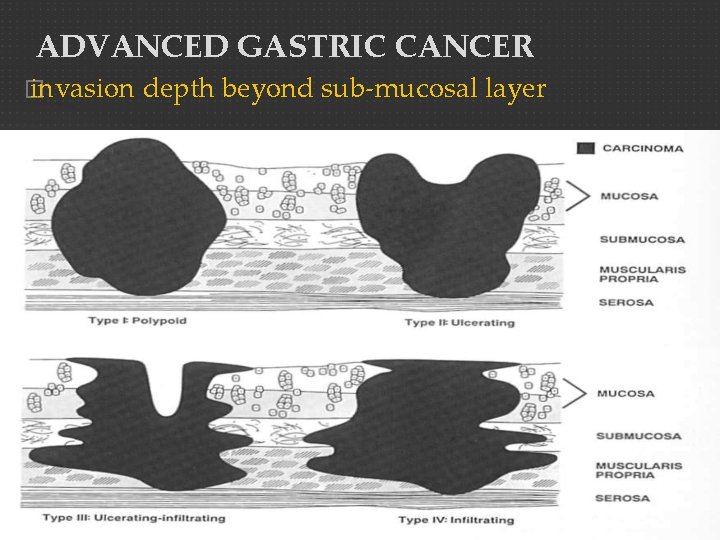 ADVANCED GASTRIC CANCER � invasion depth beyond sub-mucosal layer 