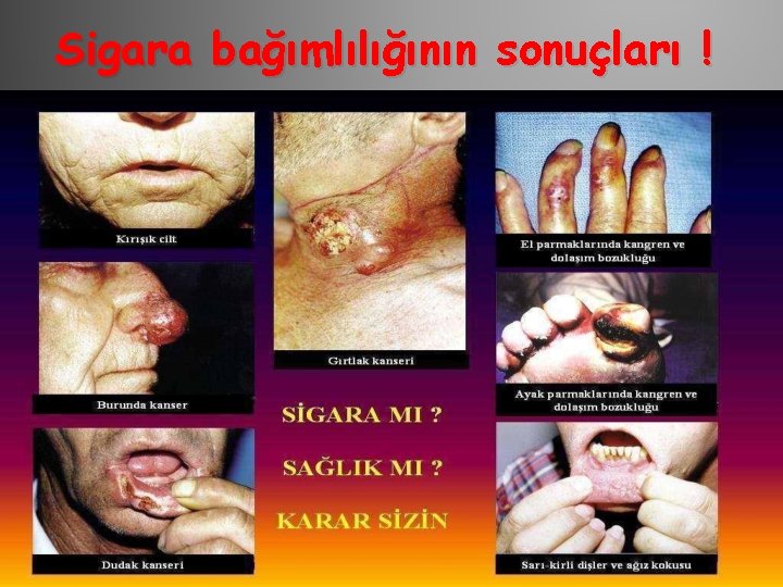 Sigara bağımlılığının sonuçları ! 