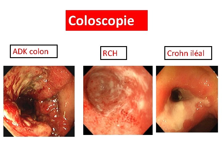 Coloscopie ADK colon RCH Crohn iléal 