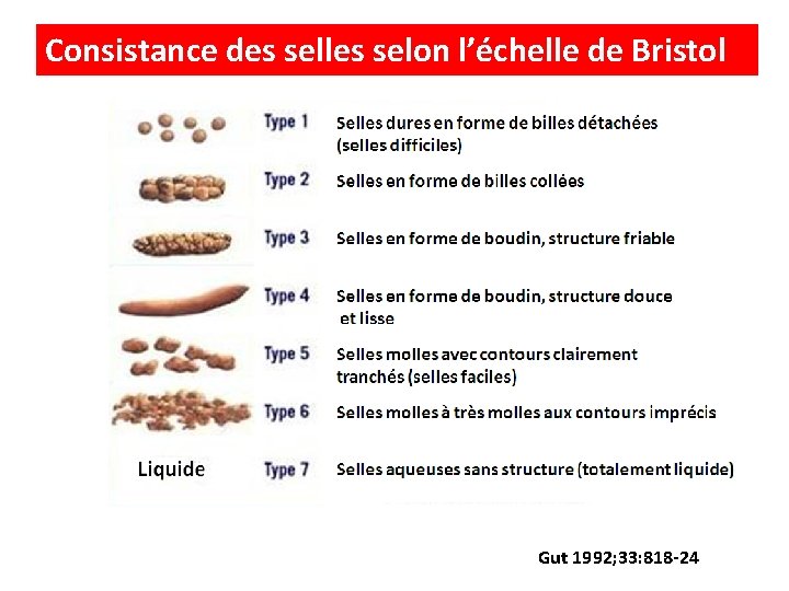 Consistance des selles selon l’échelle de Bristol Gut 1992; 33: 818 -24 