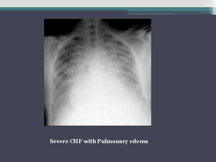 15 Severe CHF with Pulmonary edema 