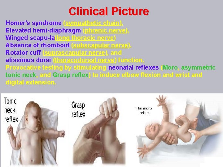 Clinical Picture Homer's syndrome (sympathetic chain), Elevated hemi diaphragm (phrenic nerve), Winged scapu la(long