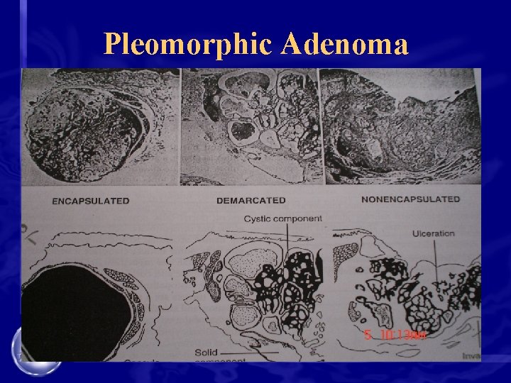 Pleomorphic Adenoma 