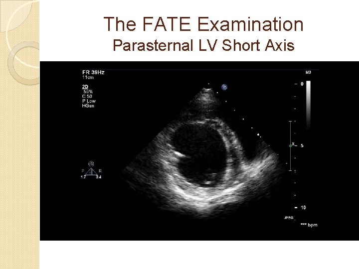 The FATE Examination Parasternal LV Short Axis 
