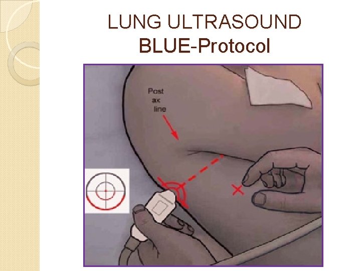 LUNG ULTRASOUND BLUE-Protocol 