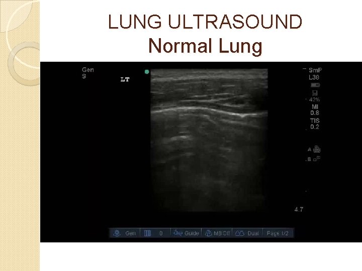 LUNG ULTRASOUND Normal Lung 