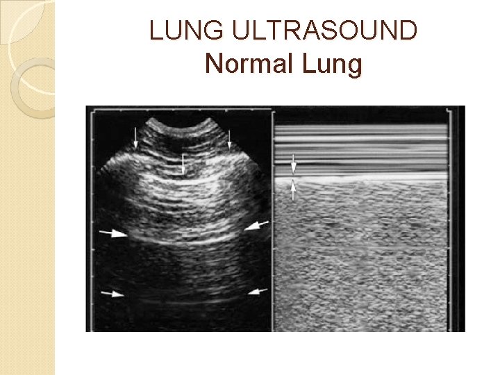 LUNG ULTRASOUND Normal Lung 