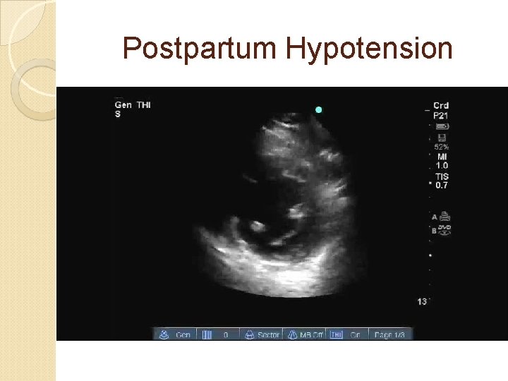 Postpartum Hypotension 
