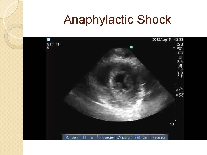 Anaphylactic Shock 